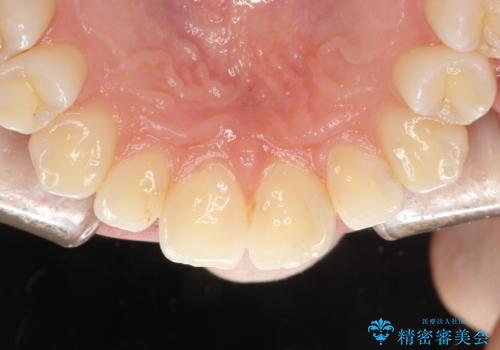 歯の着色・ステイン・ザラつき除去をPMTCでの症例 治療後