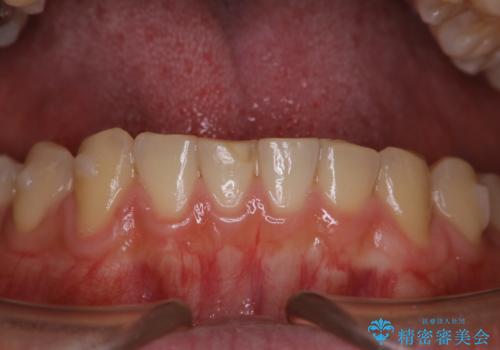 歯科医院にて染め出しをして歯磨き指導と専門的なクリーニング(PMTC)の治療前