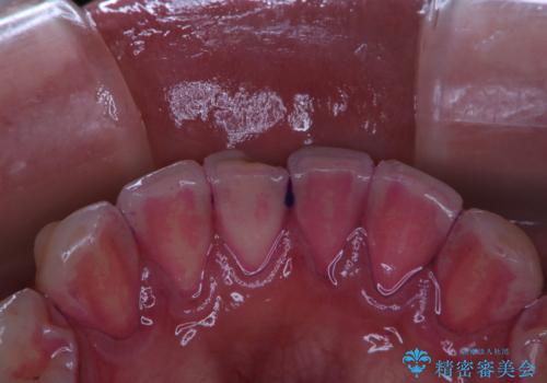 歯科医院にて染め出しをして歯磨き指導と専門的なクリーニング(PMTC)の症例 治療前