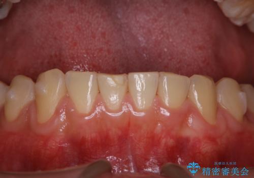 歯科医院にて染め出しをして歯磨き指導と専門的なクリーニング(PMTC)の治療後