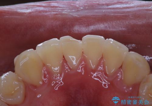 歯科医院にて染め出しをして歯磨き指導と専門的なクリーニング(PMTC)の症例 治療後