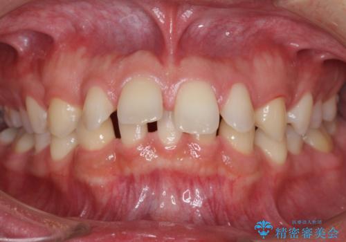 すきっ歯・出っ歯　コンプレックスの前歯を治したい　目立たない方法で　セラミック治療は不可能な症例の症例 治療前