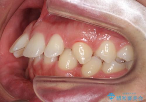 すきっ歯・出っ歯　コンプレックスの前歯を治したい　目立たない方法で　セラミック治療は不可能な症例の治療前