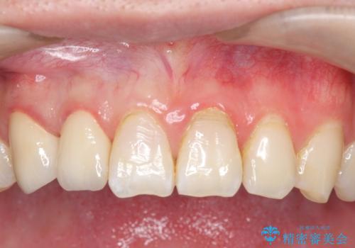 オールセラミッククラウン　色・形が気になる前歯の改善の症例 治療後