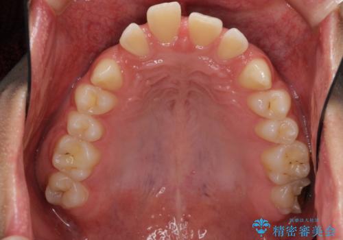 すきっ歯・出っ歯 コンプレックスの前歯を治したい 目立たない方法で セラミック治療は不可能な症例の治療前