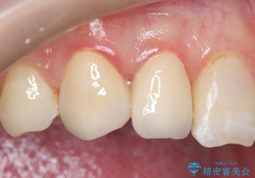 オールセラミッククラウン 色・形が気になる前歯の改善の治療後