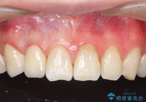 オールセラミッククラウン 色・形が気になる前歯の改善の治療後