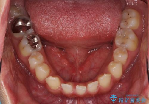 すきっ歯・出っ歯 コンプレックスの前歯を治したい 目立たない方法で セラミック治療は不可能な症例の治療前