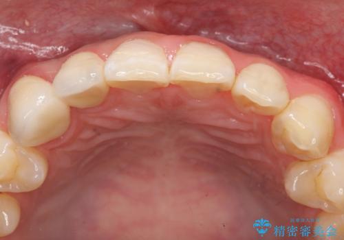 オールセラミッククラウン　色・形が気になる前歯の改善の治療後