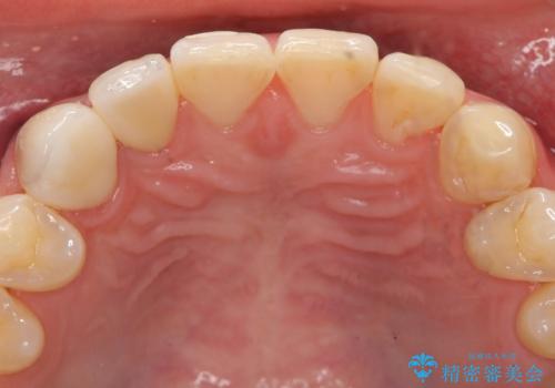 オールセラミッククラウン　色・形が気になる前歯の改善の治療後