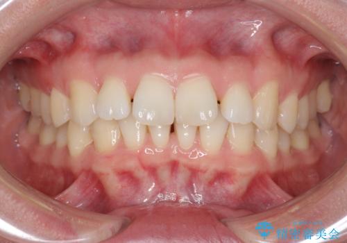 インビザライン で治す  出っ歯の治療の治療前