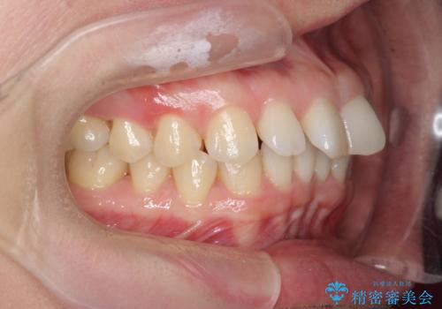 インビザライン で治す  出っ歯の治療の治療前