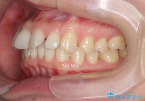 インビザライン で治す  出っ歯の治療の治療前