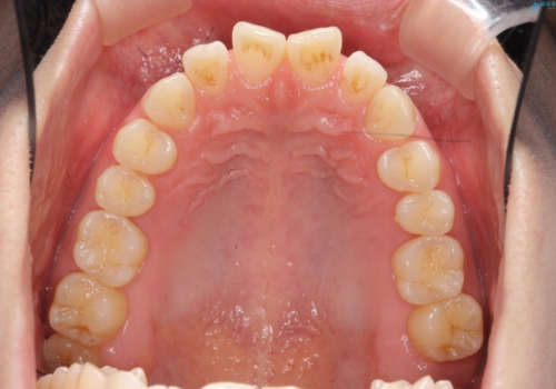インビザライン で治す  出っ歯の治療の治療前