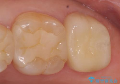 オールセラミッククラウン 欠けた歯の治療の症例 治療後