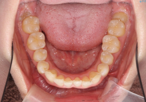 インビザライン で治す  出っ歯の治療の治療前