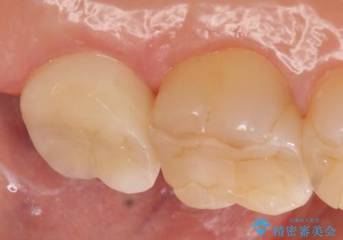 オールセラミッククラウン 欠けた歯の治療の治療後