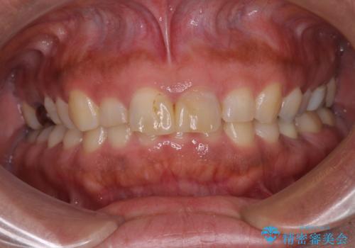 長さの気になる変色した前歯をオールセラミッククラウンにの治療前