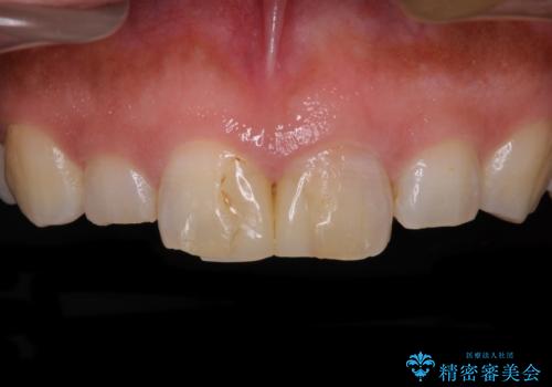 長さの気になる変色した前歯をオールセラミッククラウンにの症例 治療前
