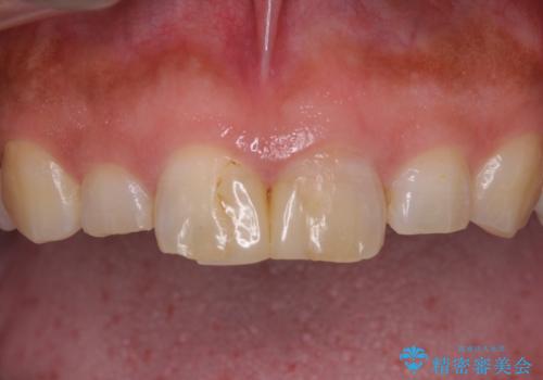 長さの気になる変色した前歯をオールセラミッククラウンにの治療前
