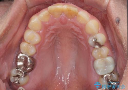 長さの気になる変色した前歯をオールセラミッククラウンにの治療前