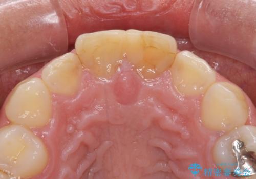 長さの気になる変色した前歯をオールセラミッククラウンにの治療前