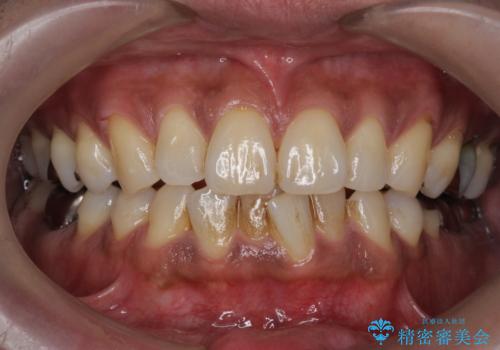 タバコによるヤニをPMTC(歯科医院での専門的クリーニング)で除去。の症例 治療前