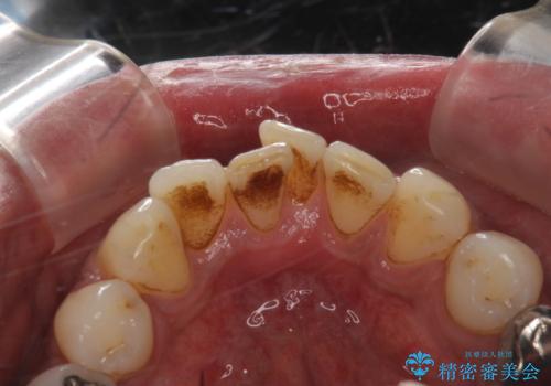 タバコによるヤニをPMTC(歯科医院での専門的クリーニング)で除去。の治療前