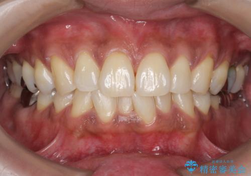 タバコによるヤニをPMTC(歯科医院での専門的クリーニング)で除去。の症例 治療後