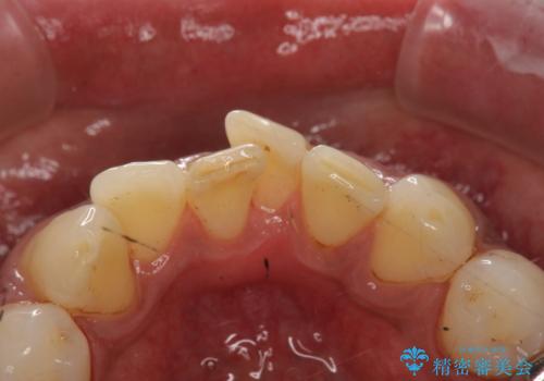 タバコによるヤニをPMTC(歯科医院での専門的クリーニング)で除去。の治療後