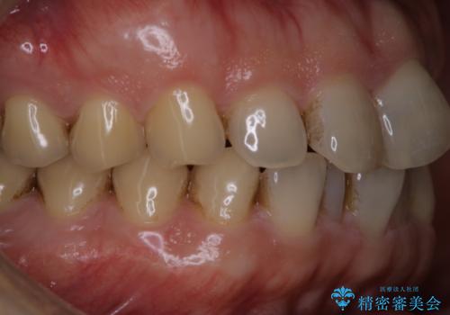 細かいステインをPMTCでOFFの治療前