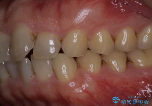 細かいステインをPMTCでOFFの治療前