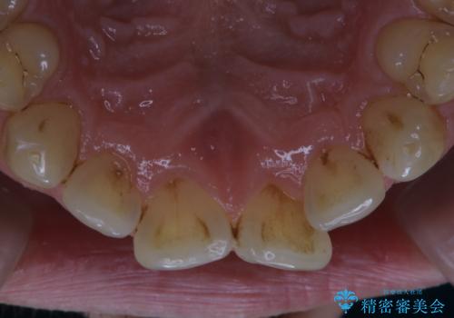 細かいステインをPMTCでOFFの治療前