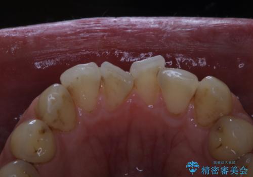 細かいステインをPMTCでOFFの治療前