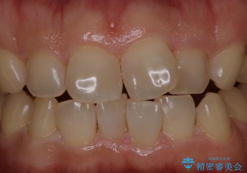 細かいステインをPMTCでOFFの治療後