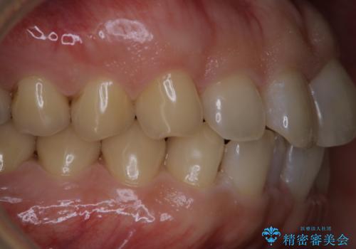 細かいステインをPMTCでOFFの治療後