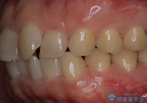 細かいステインをPMTCでOFFの治療後