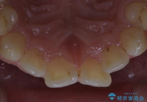 細かいステインをPMTCでOFFの治療後