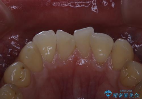 細かいステインをPMTCでOFFの治療後