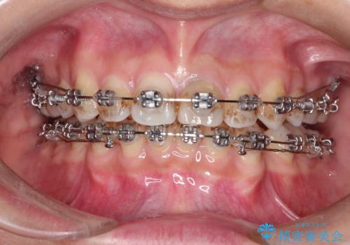 口元が出てるのが気になる 抜歯矯正でしっかりと前歯をさげてすっきりした口元への治療中