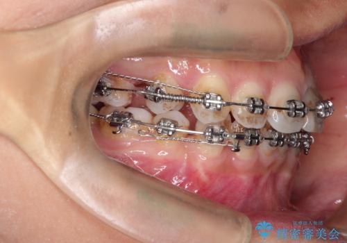 口元が出てるのが気になる 抜歯矯正でしっかりと前歯をさげてすっきりした口元への治療中