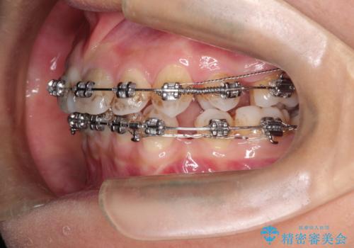 口元が出てるのが気になる 抜歯矯正でしっかりと前歯をさげてすっきりした口元への治療中