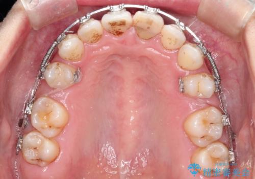 口元が出てるのが気になる　抜歯矯正でしっかりと前歯をさげてすっきりした口元への治療中