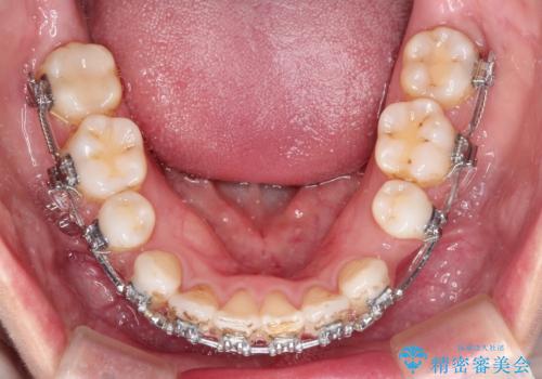 口元が出てるのが気になる　抜歯矯正でしっかりと前歯をさげてすっきりした口元への治療中