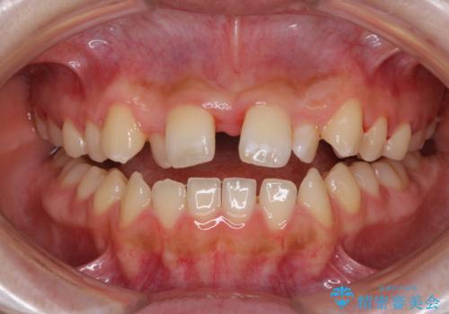 外科矯正は受けたくない 上顎骨拡大による妥協的な受け口治療の治療中