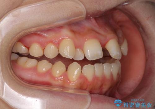 外科矯正は受けたくない 上顎骨拡大による妥協的な受け口治療の治療中