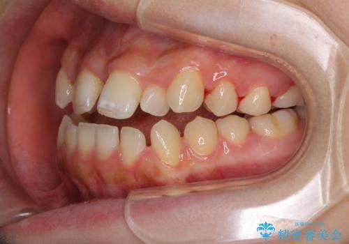 外科矯正は受けたくない 上顎骨拡大による妥協的な受け口治療の治療中