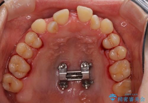 外科矯正は受けたくない 上顎骨拡大による妥協的な受け口治療の治療中