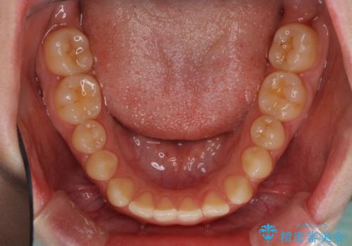 外科矯正は受けたくない 上顎骨拡大による妥協的な受け口治療の治療中