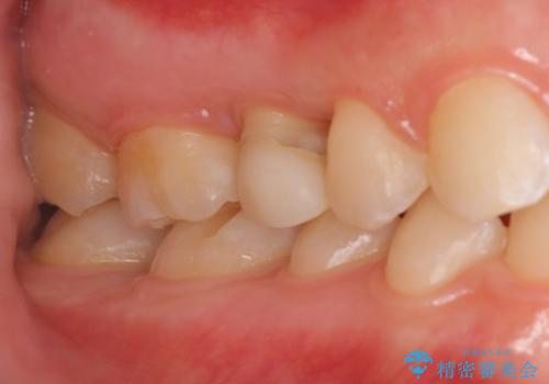 歯の高さがなく、しょっちゅう外れる 他院で治療途中だが病院を変えたいの治療中